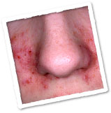 Seborrheic Dermatitis - Symptoms