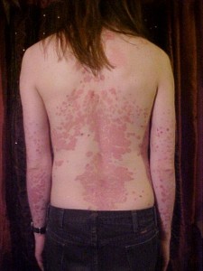 Psoriasis on the back image